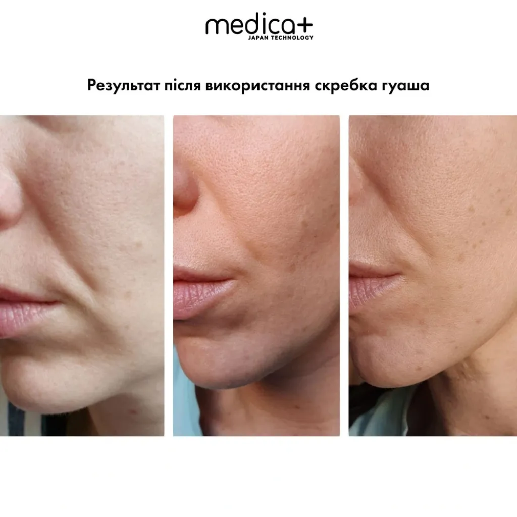 Стальной скребок гуаша для моделирования овала лица MEDICA+ Steel GuaSha Стальной скребок гуаша для моделирования овала лица MEDICA+ Steel GuaSha