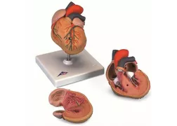 Серце з гіпертрофією лівого шлуночка