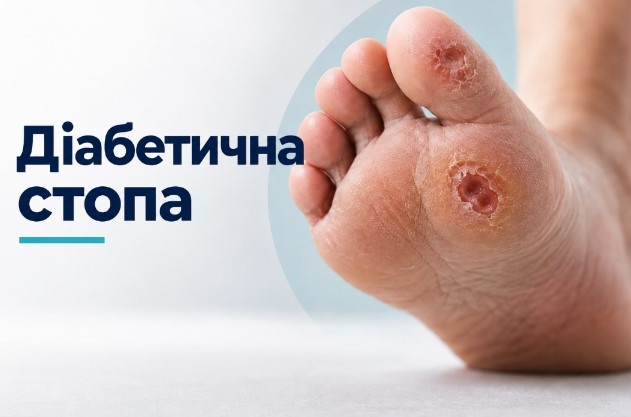 Диабетическая стопа с язвенными поражениями и сухостью кожи на подошве.