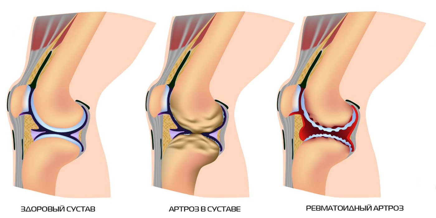 Боль в локте: почему болит локтевой сустав и что с этим делать?