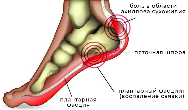 Почему болит стопа правой ноги: причины и лечение