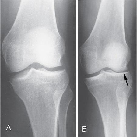 Бандаж на коленный сустав при болезни Шляттера