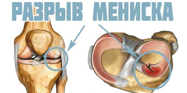 Хирургическое лечение разрывов и повреждений мениска коленного сустава