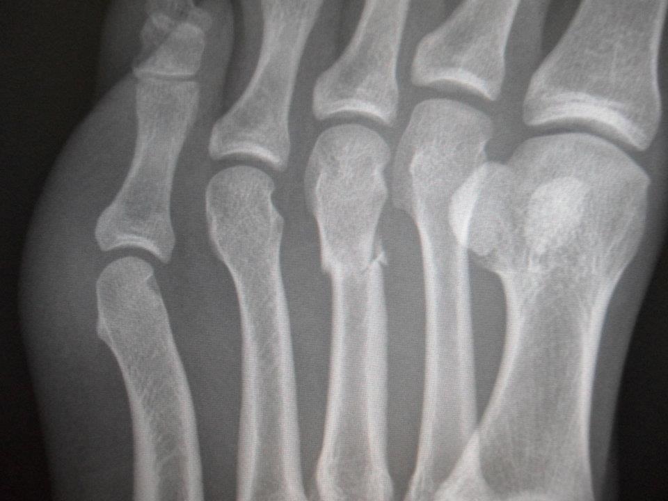 Ортопедические стельки после перелома плюсневой