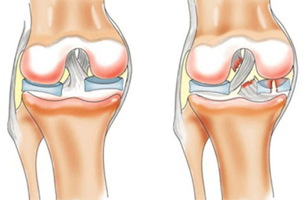 Лечение растяжения связок под коленом сзади | Клиника Temed