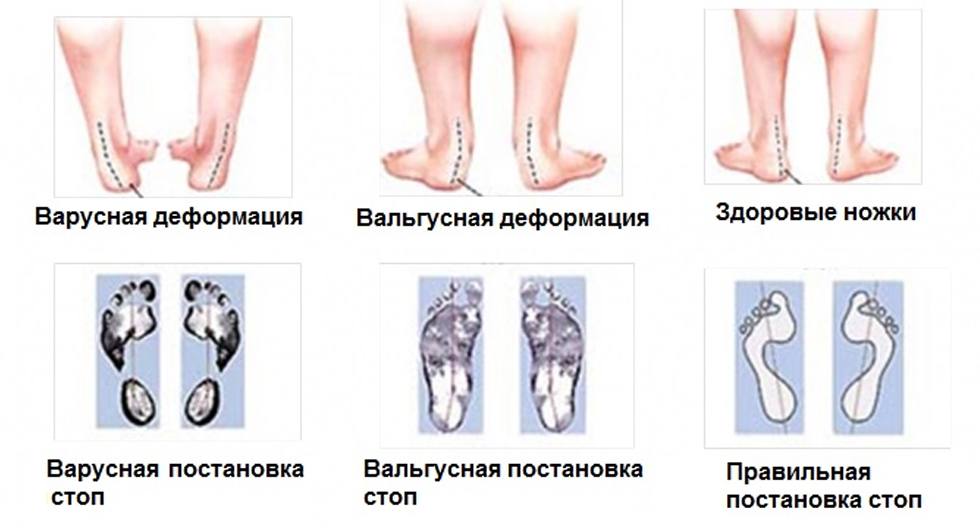 Почему болит косточка на ноге возле большого пальца: причины и лечение