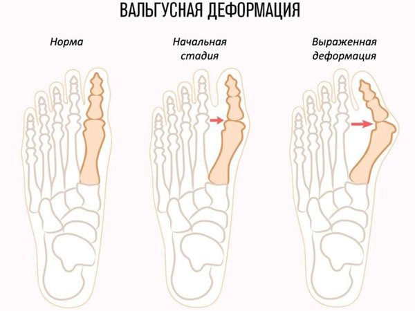 Особенности строения пальцев ног